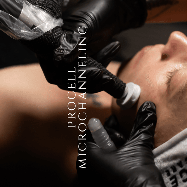 Procell MD Microchanneling x 6 at R&R Aesthetics - Prescott, Arizona in Prescott, AZ